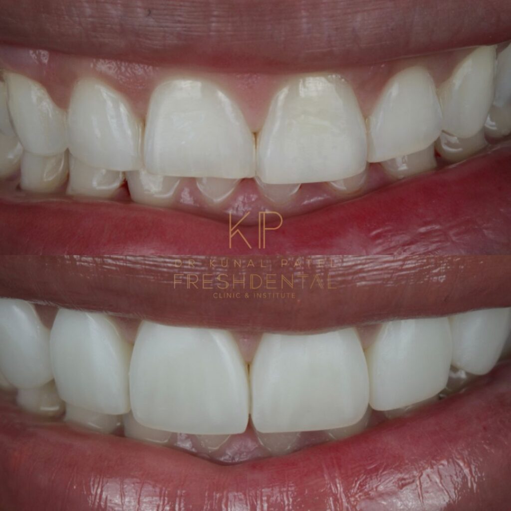 Fresh Dental composite bonding result 1