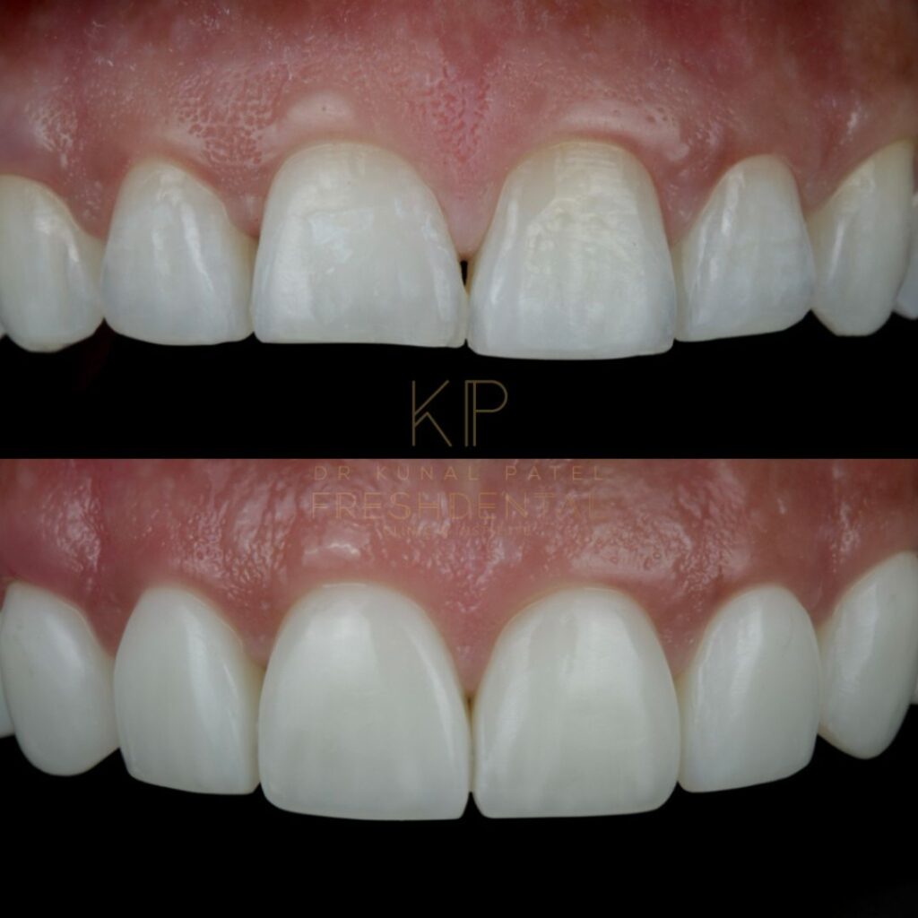 Fresh Dental composite bonding result 2