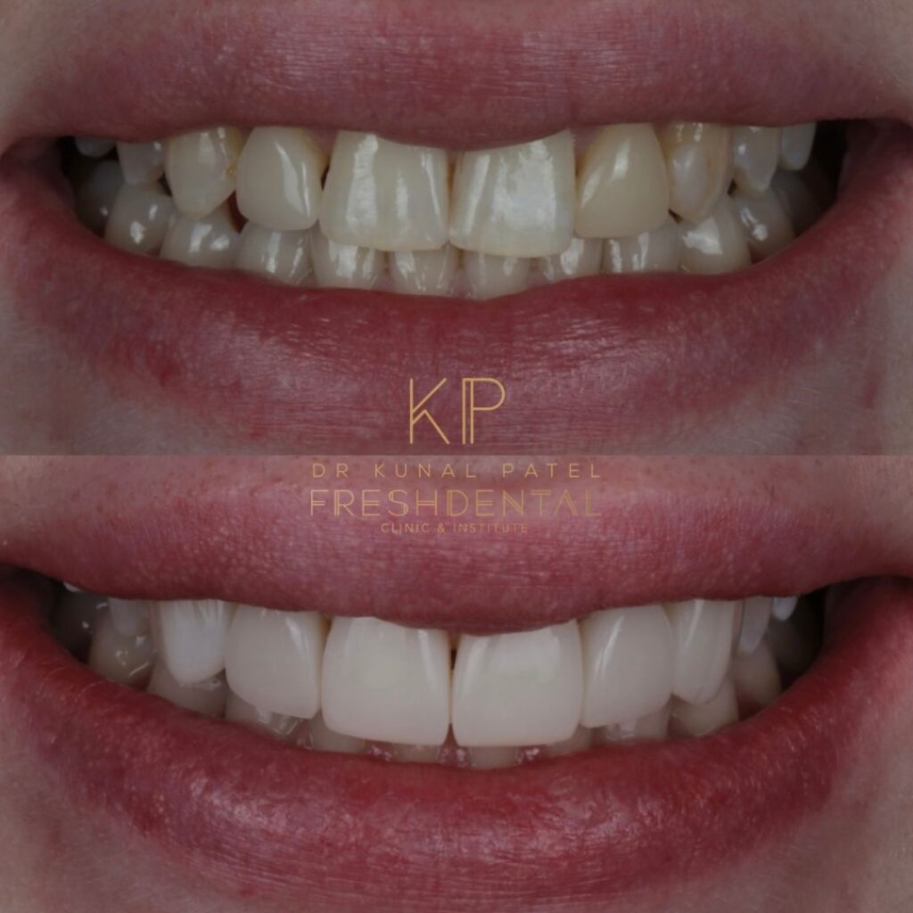 Fresh Dental composite bonding result 4