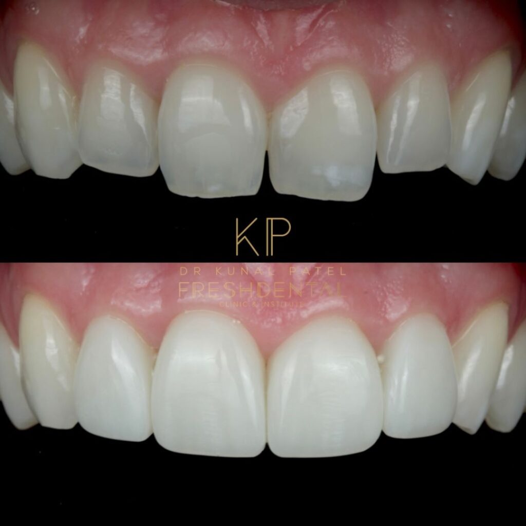 Fresh Dental composite bonding result 6
