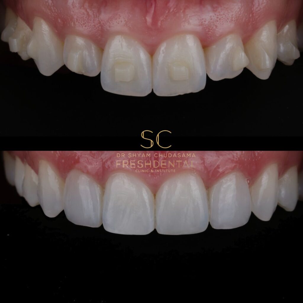 Fresh Dental composite bonding result 7