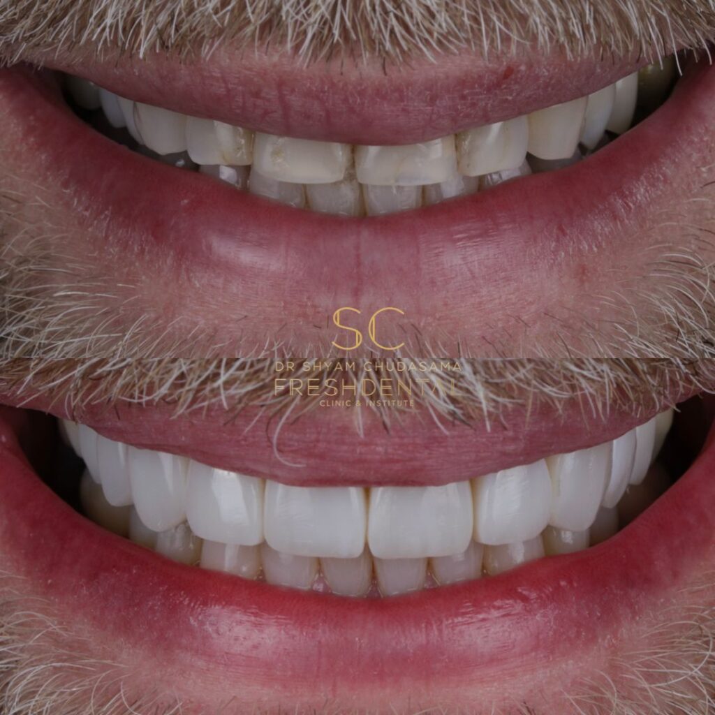 Fresh Dental composite bonding result 8