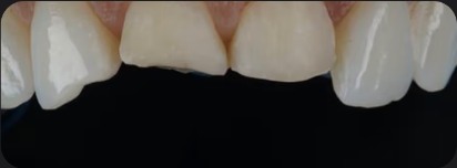 Composite shade selection at Fresh Dental