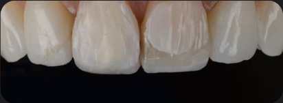 Preparing and bonding the tooth for composite bonding at Fresh Dental